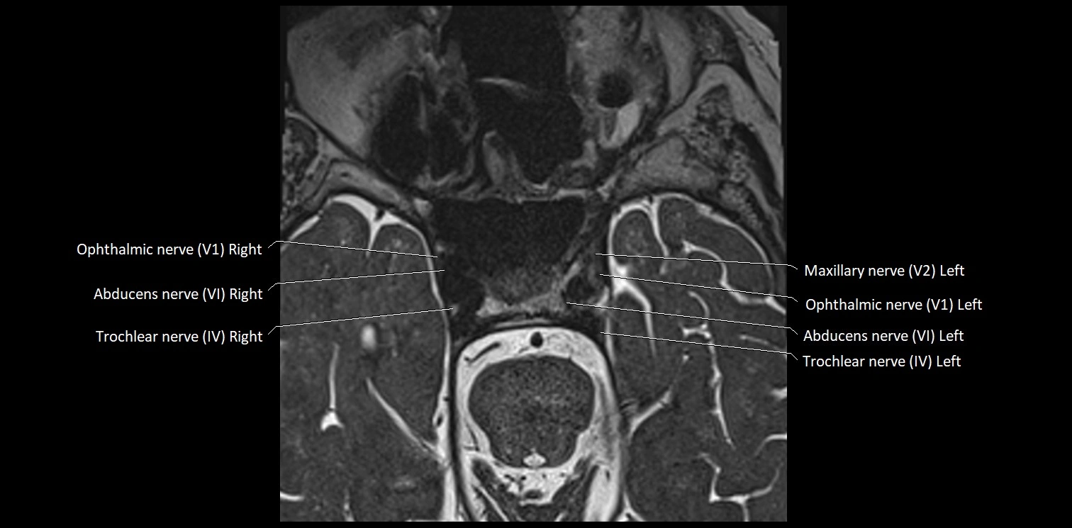 Cranial nerve anatomy axial MRI 3T image 33.webp